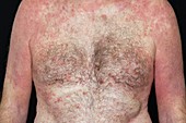 Eczema on the torso