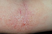 Atopic eczema in a child