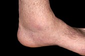 Gout of the ankle