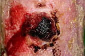 Squamous cell cancer on the leg