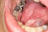 Squamous cell cancer in the mouth