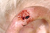Basal cell carcinoma on the ear