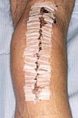 Knee replacement wound
