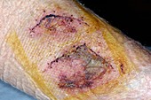 Dog bite wounds after suturing