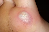 Blister due to stepping on glass