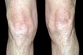 Swollen joint of the knee after a fall