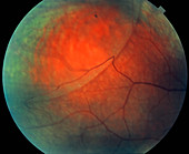 Retinoschisis of the eye's retina