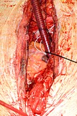 Open heart surgery