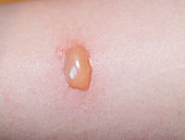 Poison Ivy rash on human skin