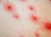 Chickenpox