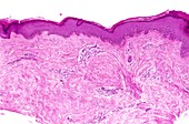 Keratoacanthoma,light micrograph