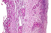 Ovarian cyst,light micrograph