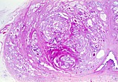 Prostate hyperplasia,light micrograph