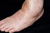 Swollen foot from surgery (arthrodesis)