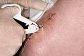 Staple removal from knee replacement
