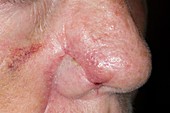 Excised basal cell cancer on nose