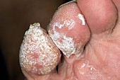 Chronic warts on the toes