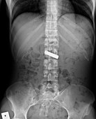 Swallowed battery,X-ray