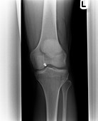 Firearm injury,X-ray