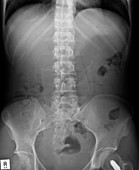 Swallowed needles,X-ray
