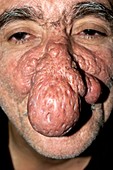 Rhinophyma of the nose