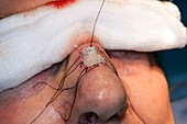 Basal cell carcinoma surgery