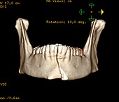 Broken chin,3D CT scan