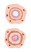 Asthma pathology,artwork