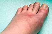 Gout affecting the foot