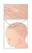 Cradle cap,artwork