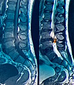Spinal nerve pain,MRI scans