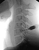 Neck pain treatment,X-ray
