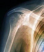 Arthritic shoulder,X-ray