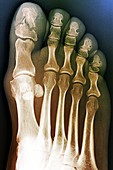 Broken toe bone,X-ray