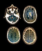 Pyramidal brain syndrome,MRI scans