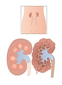 Polycystic kidneys