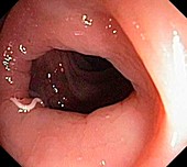 Pinworm,endoscope image