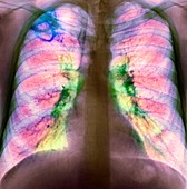 Drug use lung damage,X-ray