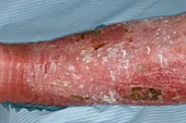 Chronic infected varicose eczema