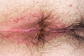 Dermatitis around the anus