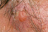 Squamous cell cancer on the face