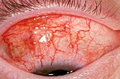Episcleritis (reddening) of the eye