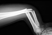Broken arm,X-ray