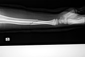 Broken arm in a cast,X-ray