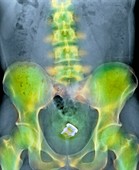 Drinks bottle in man's rectum,X-ray