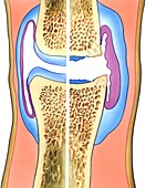 Osteoarthritis of the knee,artwork