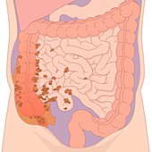 Ruptured appendix,artwork