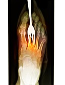 Foot fork-stabbing injury,X-ray