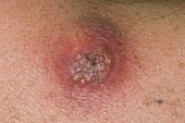 Sebaceous cyst on the shoulder