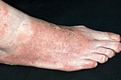 Infected eczema on the foot